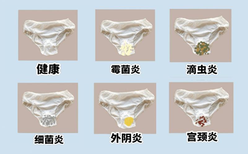 孕期外阴湿疹擦什么药膏才安全有效？-第2张图片-郑州医学网