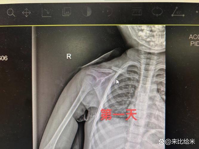 新生儿右锁骨骨折图片，是分娩损伤还是医疗疏忽？如何判断与应对？-第1张图片-郑州医学网