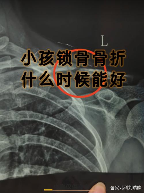 新生儿右锁骨骨折图片，是分娩损伤还是医疗疏忽？如何判断与应对？-第2张图片-郑州医学网