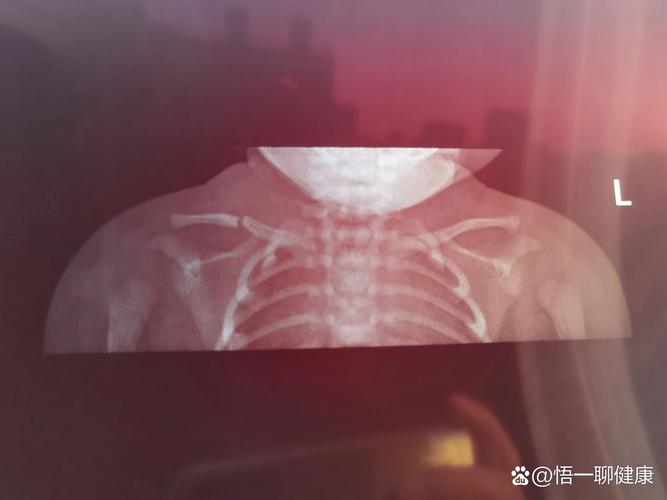 新生儿右锁骨骨折图片，是分娩损伤还是医疗疏忽？如何判断与应对？-第3张图片-郑州医学网