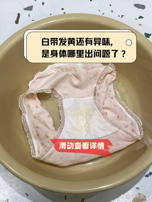 孕期白带发黄是正常现象吗？需要警惕哪些异常情况？-第1张图片-郑州医学网