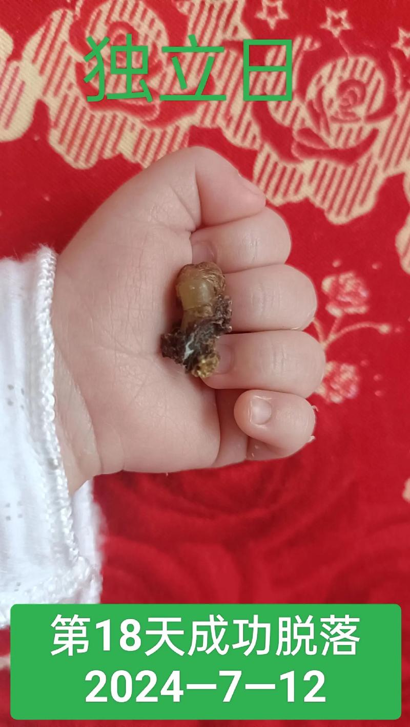 新生儿脐带刚脱落图片正常吗？需要注意哪些护理细节？-第2张图片-郑州医学网