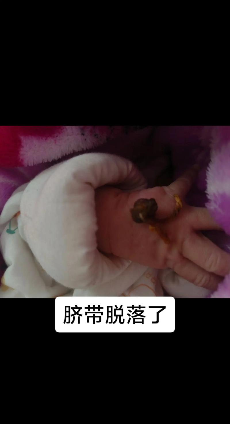 新生儿脐带刚脱落图片正常吗？需要注意哪些护理细节？-第3张图片-郑州医学网