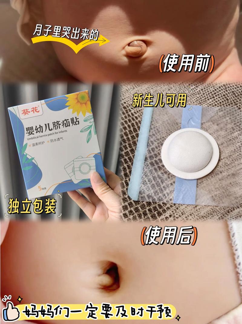 新生儿肚脐为何迟迟不闭合？背后藏着哪些健康隐患？-第2张图片-郑州医学网