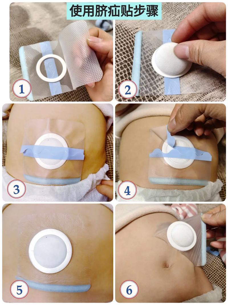 新生儿肚脐为何迟迟不闭合？背后藏着哪些健康隐患？-第3张图片-郑州医学网