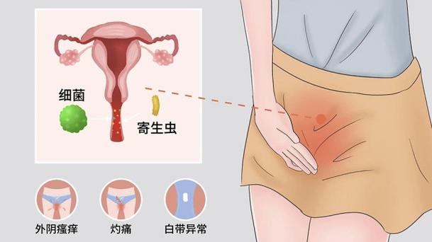 孕期阴部长湿疹，该如何安全治疗与日常护理？-第2张图片-郑州医学网