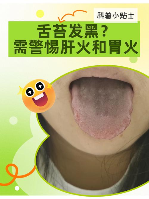 孕期舌头发黑怎么回事-第3张图片-郑州医学网