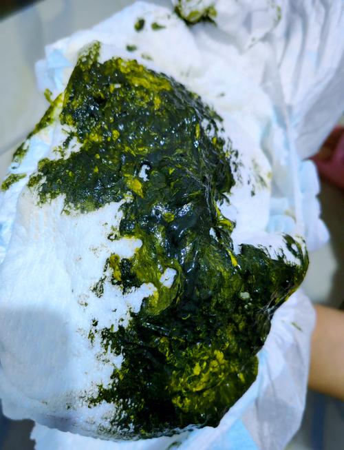 新生儿大便绿色是正常现象还是健康警报？家长该如何科学判断与应对？-第3张图片-郑州医学网