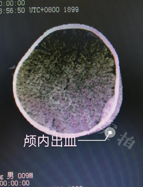 新生儿脑轻微出血是普遍现象吗？会对发育有影响吗？-第1张图片-郑州医学网
