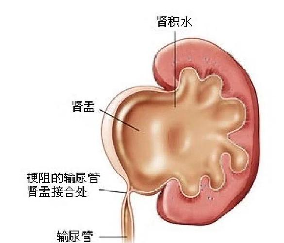 新生儿肾盂分离的自愈率究竟有多高？不同情况下的自愈可能性又有多大呢？-第2张图片-郑州医学网