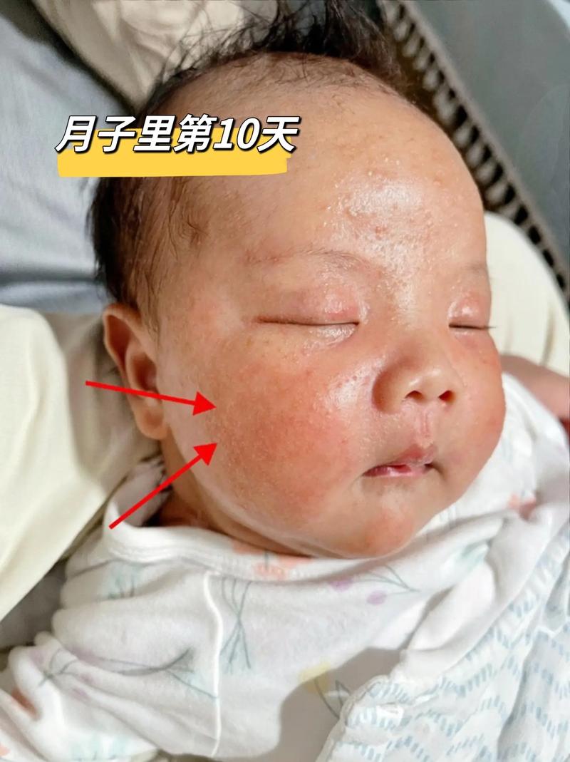 新生儿黄疸嗜睡是病情加重的信号吗？家长该如何判断与应对？-第2张图片-郑州医学网