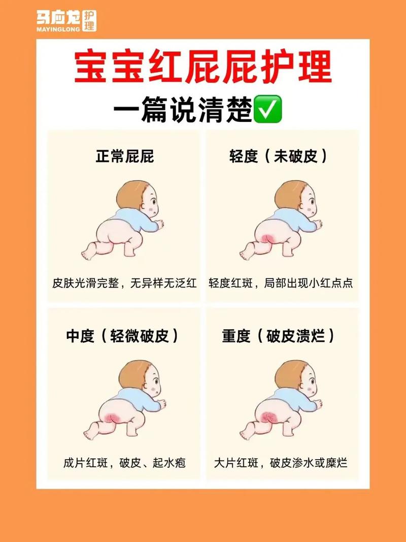 新生儿屁屁红反反复复，到底怎么护理才能好得快又不伤皮肤？-第1张图片-郑州医学网