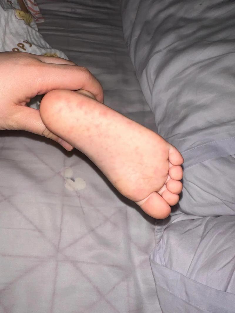 新生儿脚底红点图片是正常现象吗？需要担心吗？-第2张图片-郑州医学网