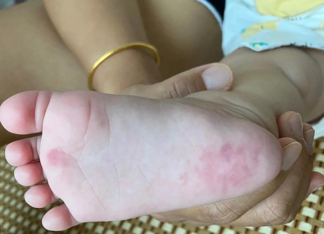 新生儿脚底红点图片是正常现象吗？需要担心吗？-第3张图片-郑州医学网