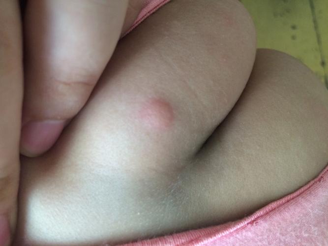 儿童屁股上长包是什么原因？需要根据图片特征判断吗？-第1张图片-郑州医学网