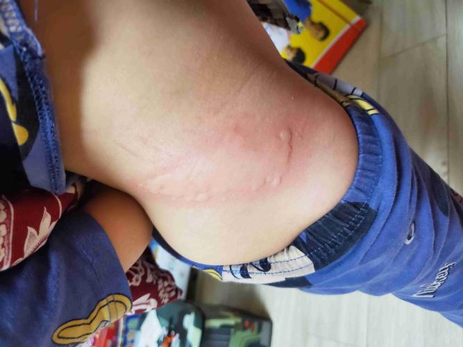 儿童屁股上长包是什么原因？需要根据图片特征判断吗？-第2张图片-郑州医学网