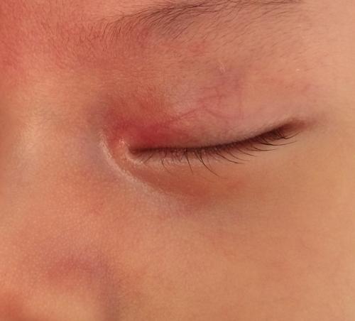 新生儿眼珠旁边出现红色是何原因？需警惕哪些眼部问题？-第1张图片-郑州医学网