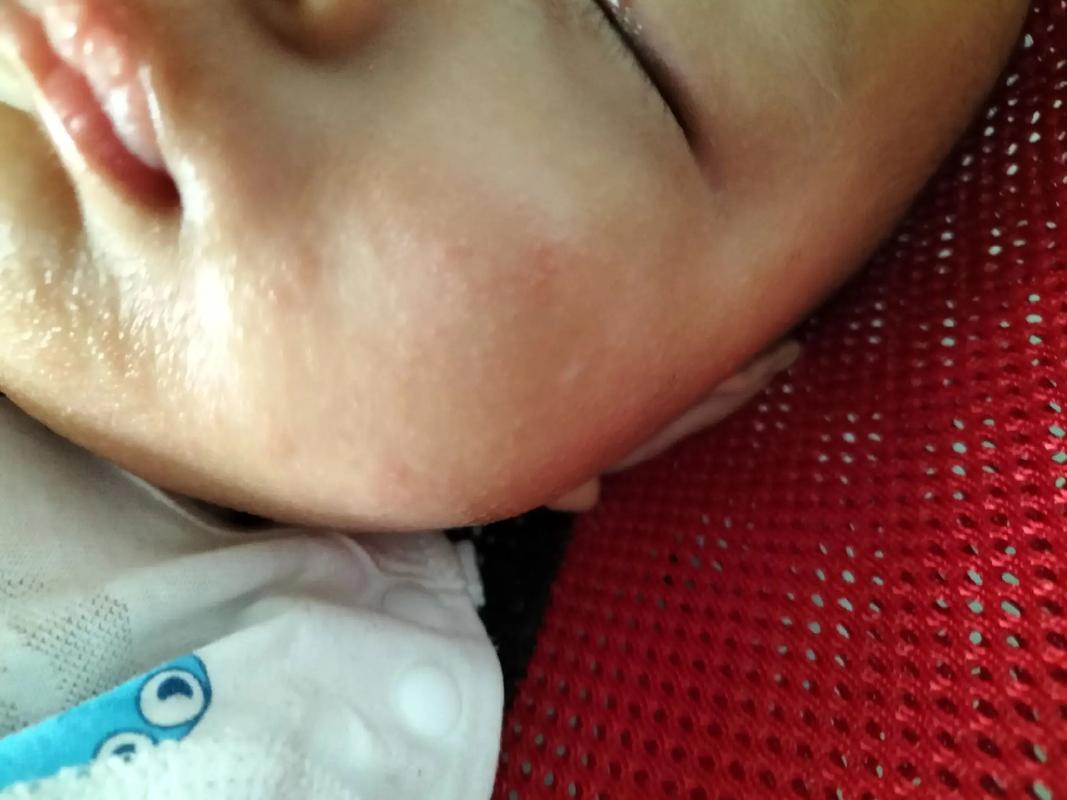 新生儿眼珠旁边出现红色是何原因？需警惕哪些眼部问题？-第2张图片-郑州医学网