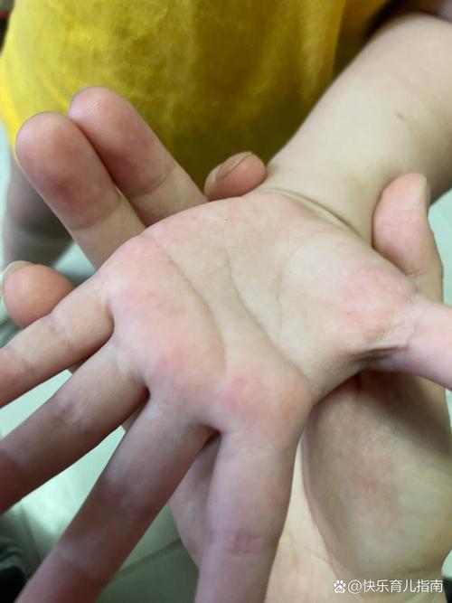 新生儿手上有红点图片是湿疹还是过敏？需要担心吗？-第2张图片-郑州医学网