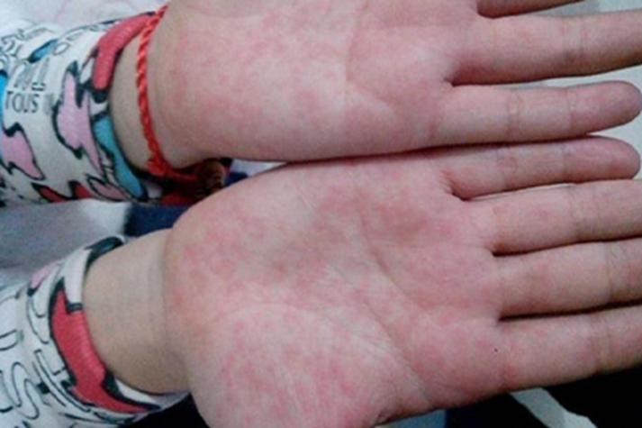 新生儿手上有红点图片是湿疹还是过敏？需要担心吗？-第3张图片-郑州医学网