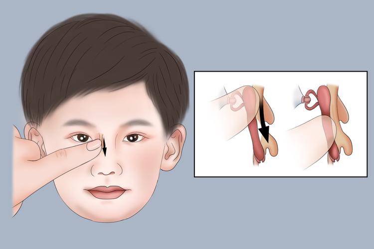 新生儿泪管不通按摩图具体手法步骤是怎样的？-第2张图片-郑州医学网