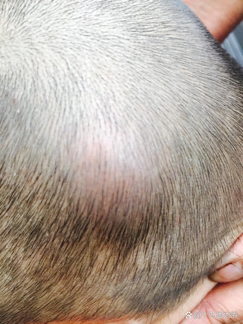 新生儿头发里出现脓包是正常现象吗？需要怎么处理？-第2张图片-郑州医学网