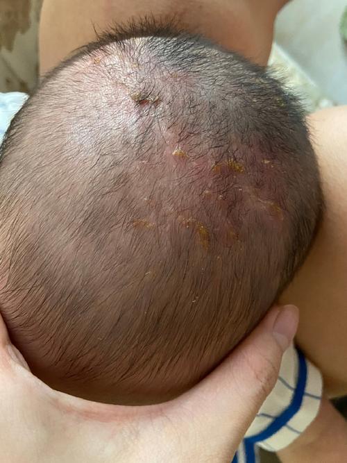 新生儿头发里出现脓包是正常现象吗？需要怎么处理？-第1张图片-郑州医学网