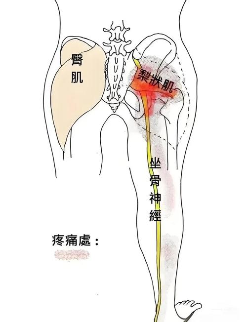 孕期屁股酸痛是胎儿压迫还是缺钙？这些原因别忽视！-第1张图片-郑州医学网