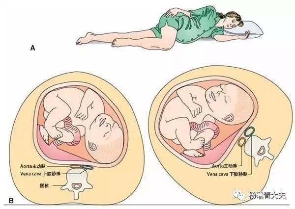 孕期外阴静脉曲张有哪些症状？如何缓解与预防？-第1张图片-郑州医学网