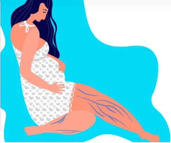 孕期外阴静脉曲张有哪些症状？如何缓解与预防？-第2张图片-郑州医学网