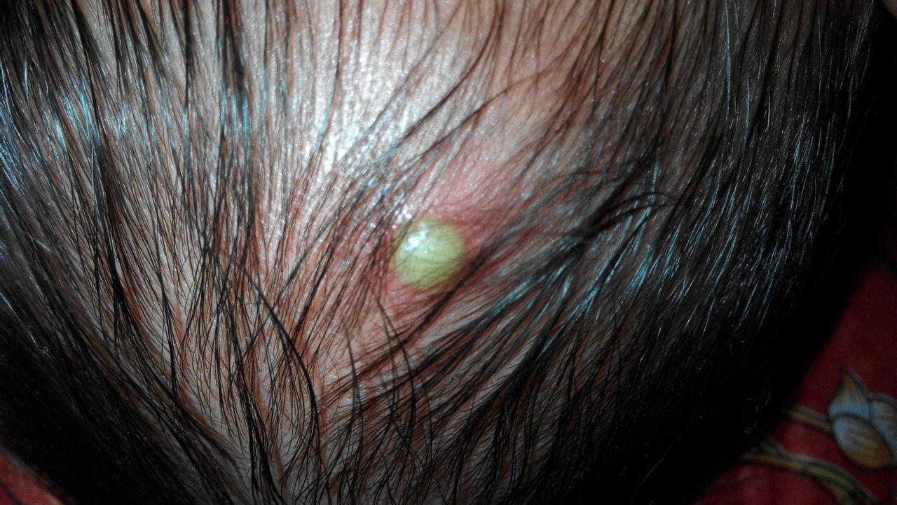 新生儿头顶白色脓包是痱子还是湿疹？需要立即处理吗？-第1张图片-郑州医学网