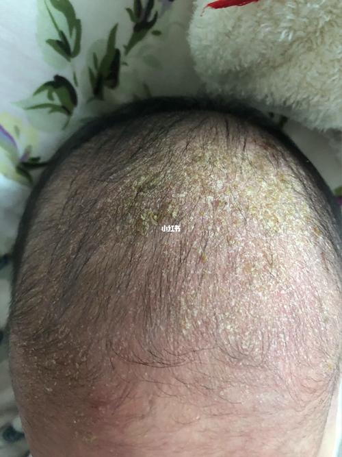 新生儿头顶白色脓包是痱子还是湿疹？需要立即处理吗？-第2张图片-郑州医学网