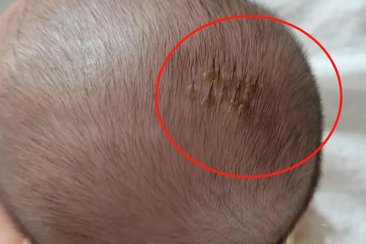 新生儿头顶白色脓包是痱子还是湿疹？需要立即处理吗？-第3张图片-郑州医学网