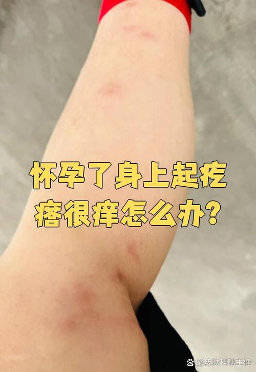 孕期痒疹有哪些安全有效的治疗方法？-第2张图片-郑州医学网