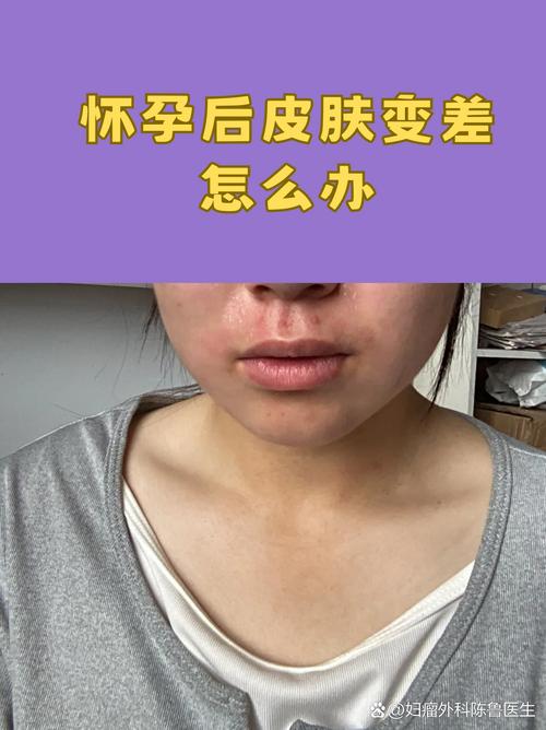 孕期皮肤变差真能预示胎儿性别是男孩吗？科学依据是什么？-第1张图片-郑州医学网