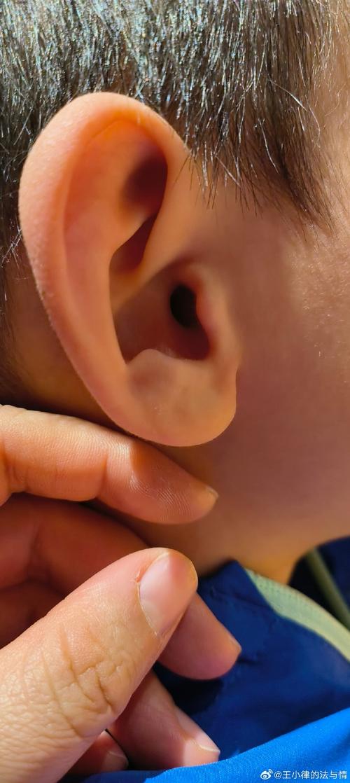 新生儿耳朵上的小白点是什么？需要处理吗？会对听力有影响吗？-第1张图片-郑州医学网