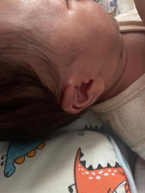 新生儿耳朵上的小白点是什么？需要处理吗？会对听力有影响吗？-第3张图片-郑州医学网