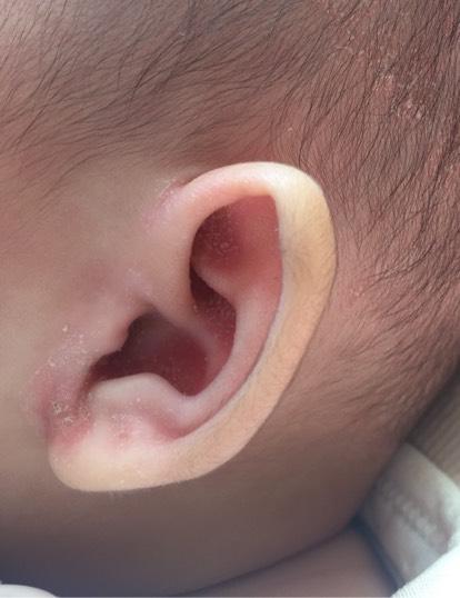 新生儿耳朵上的小白点是什么？需要处理吗？会对听力有影响吗？-第2张图片-郑州医学网