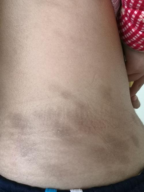 孕期身上出现褐色花斑是何原因？对胎儿健康有影响吗？-第1张图片-郑州医学网