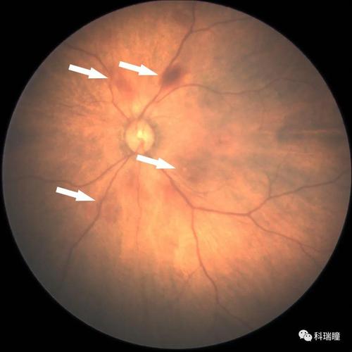 新生儿眼底渗出严重吗？会不会影响视力发育，需要紧急治疗吗？-第1张图片-郑州医学网