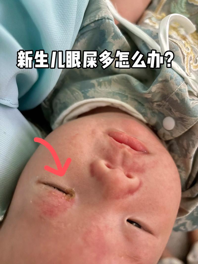 新生儿眼底渗出严重吗？会不会影响视力发育，需要紧急治疗吗？-第2张图片-郑州医学网