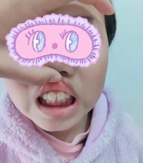 儿童牙槽骨突出图片-第2张图片-郑州医学网