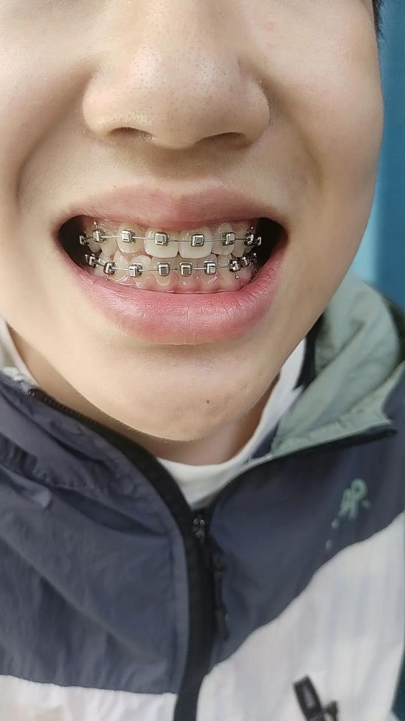 儿童牙槽骨突出图片-第1张图片-郑州医学网