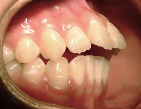 儿童牙槽骨突出图片-第3张图片-郑州医学网