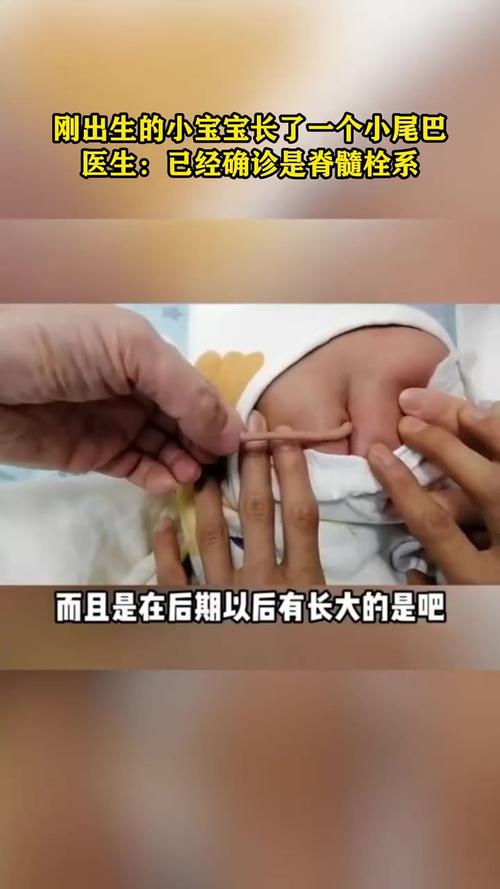 新生儿尾巴骨有眼图片是怎么回事？是先天畸形还是异常发育？-第3张图片-郑州医学网