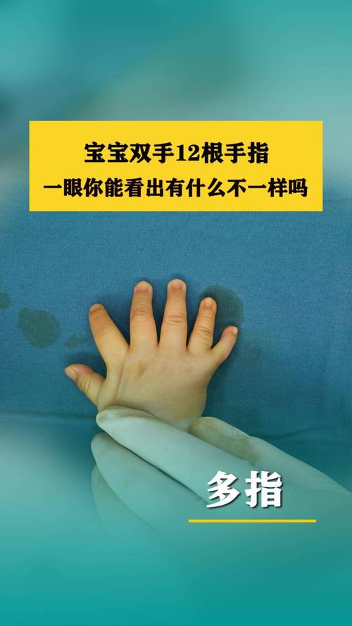 新生儿手指偏长是发育异常信号？还是健康优势体现？-第1张图片-郑州医学网