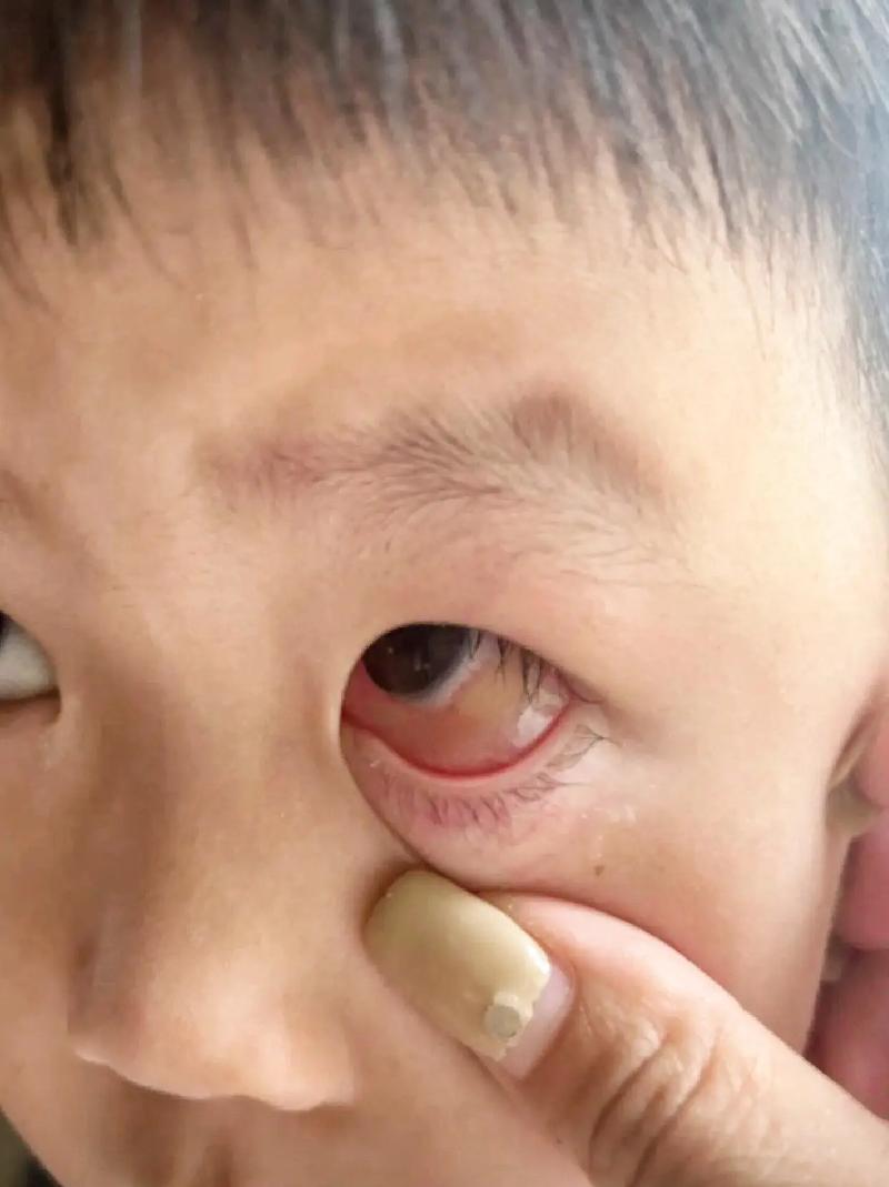 新生儿眼睛震颤是正常生理现象还是异常信号？需警惕哪些潜在病因？-第2张图片-郑州医学网