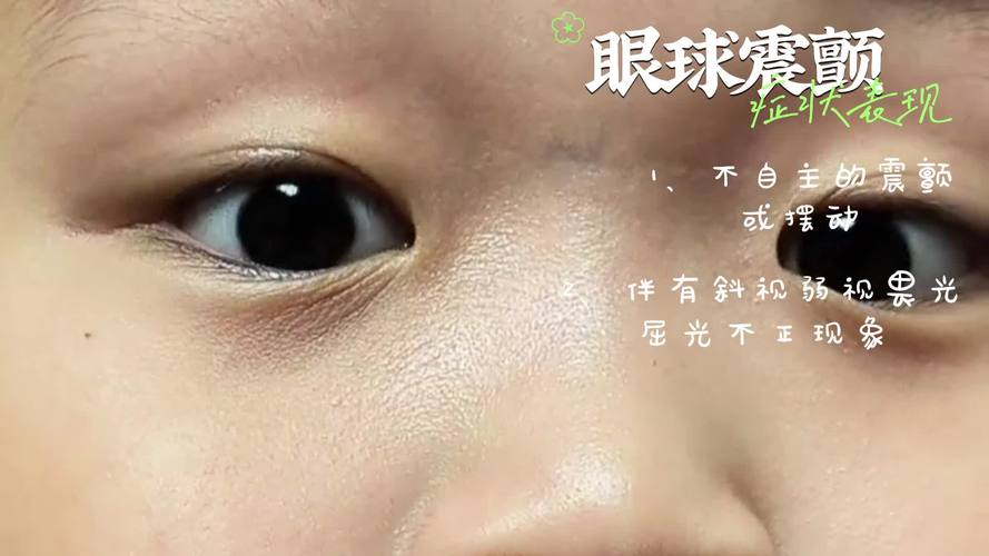 新生儿眼睛震颤是正常生理现象还是异常信号？需警惕哪些潜在病因？-第1张图片-郑州医学网