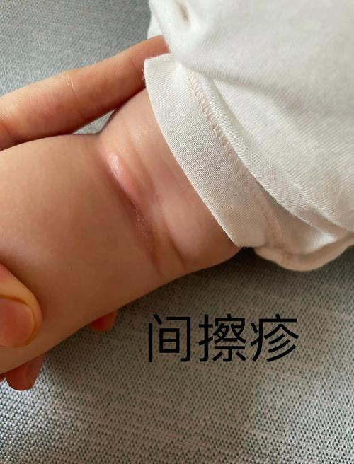 新生儿胳膊上种花图片-第2张图片-郑州医学网