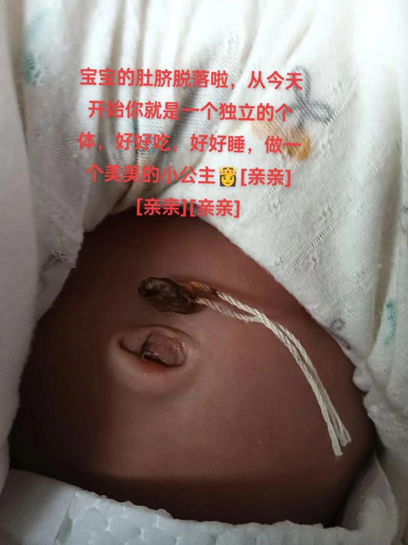 新生儿脐带未脱落时被尿湿了怎么办？需要立即处理吗？-第2张图片-郑州医学网